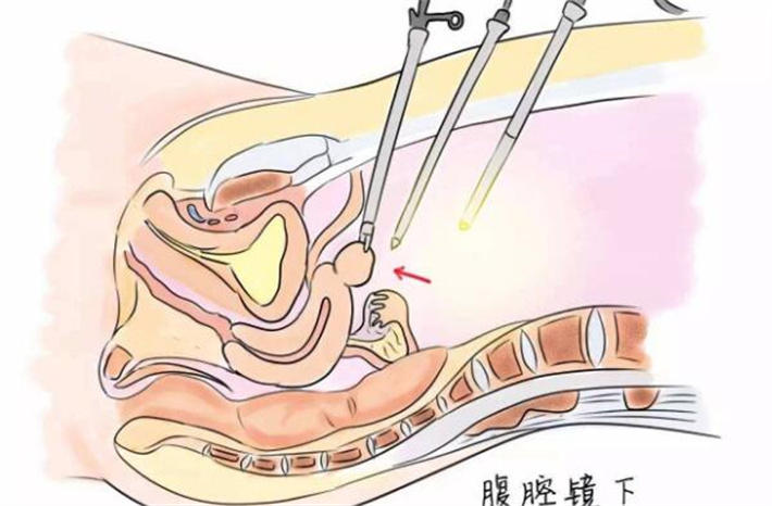 腹腔镜