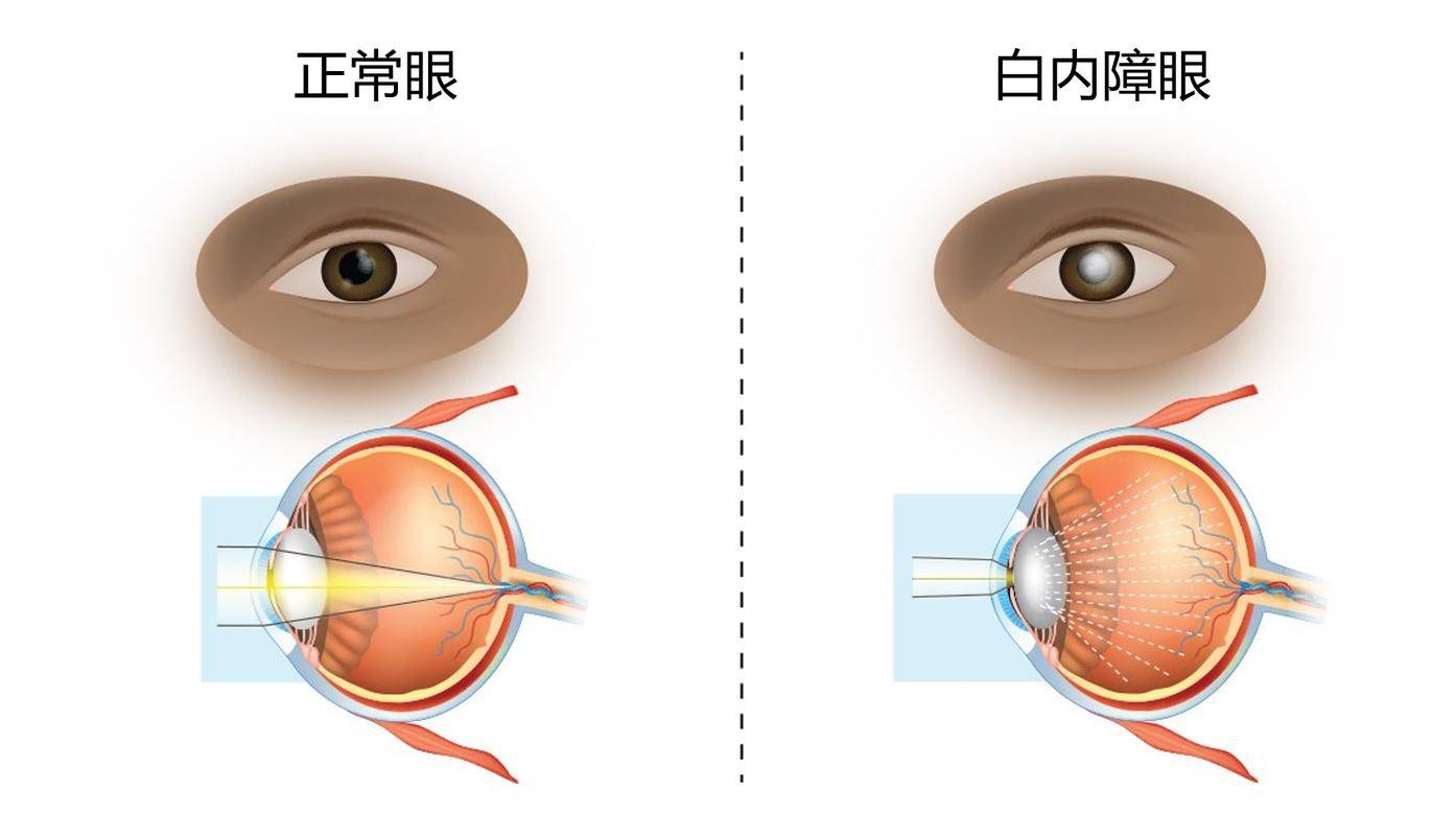 白内障