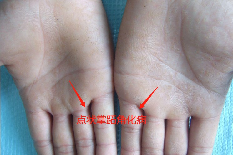 点状掌跖角化病