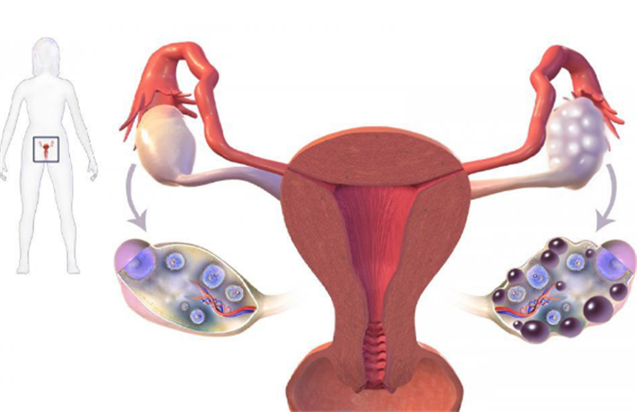 多囊卵巢综合征（PCOS）导致的稀发月经或闭经