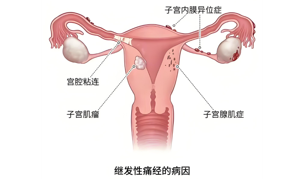 继发性痛经