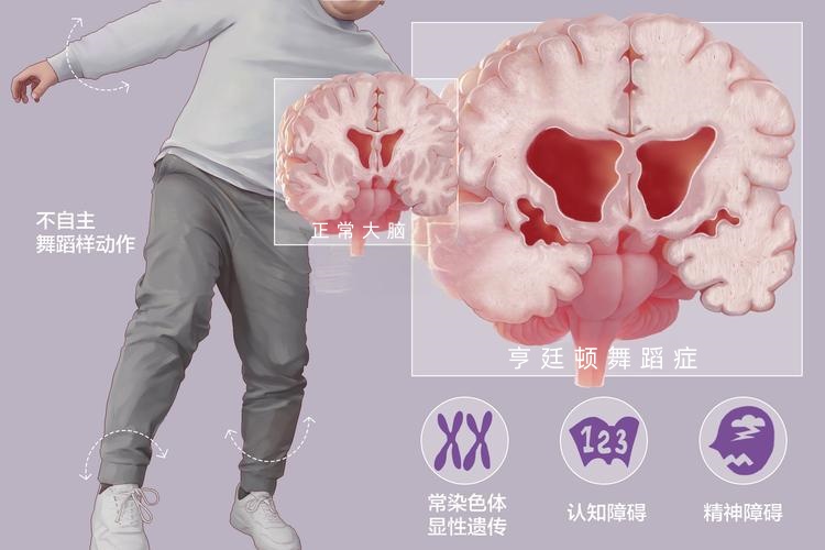 亨廷顿舞蹈症