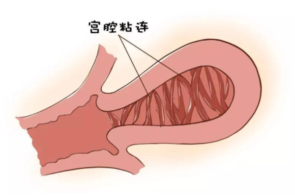 宫腔粘连.png