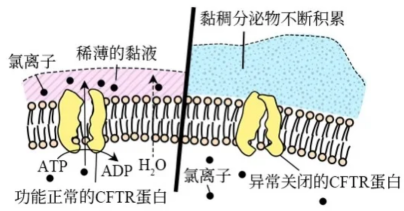 囊性纤维化