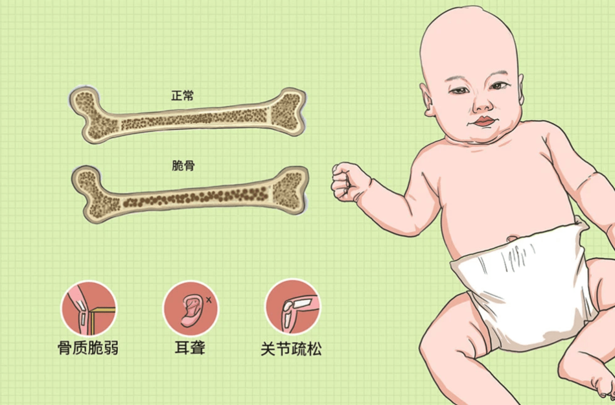 成骨不全症