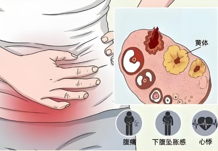 黄体破裂