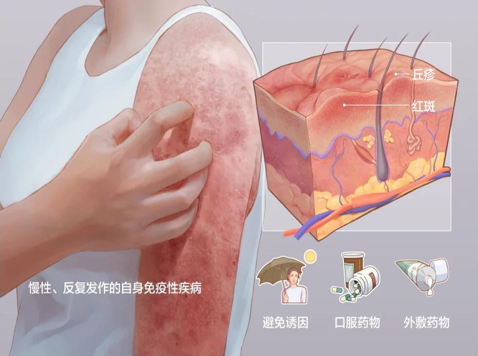 系统性红斑狼疮患者