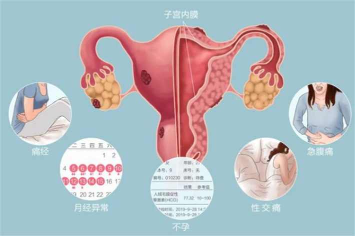 子宫异位症