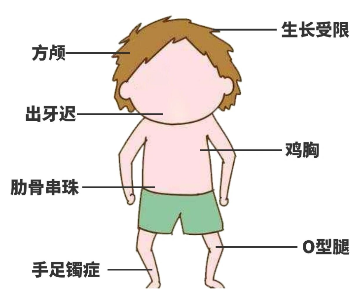 低磷性佝偻病表现