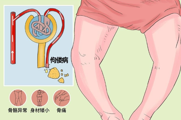 低磷性佝偻病