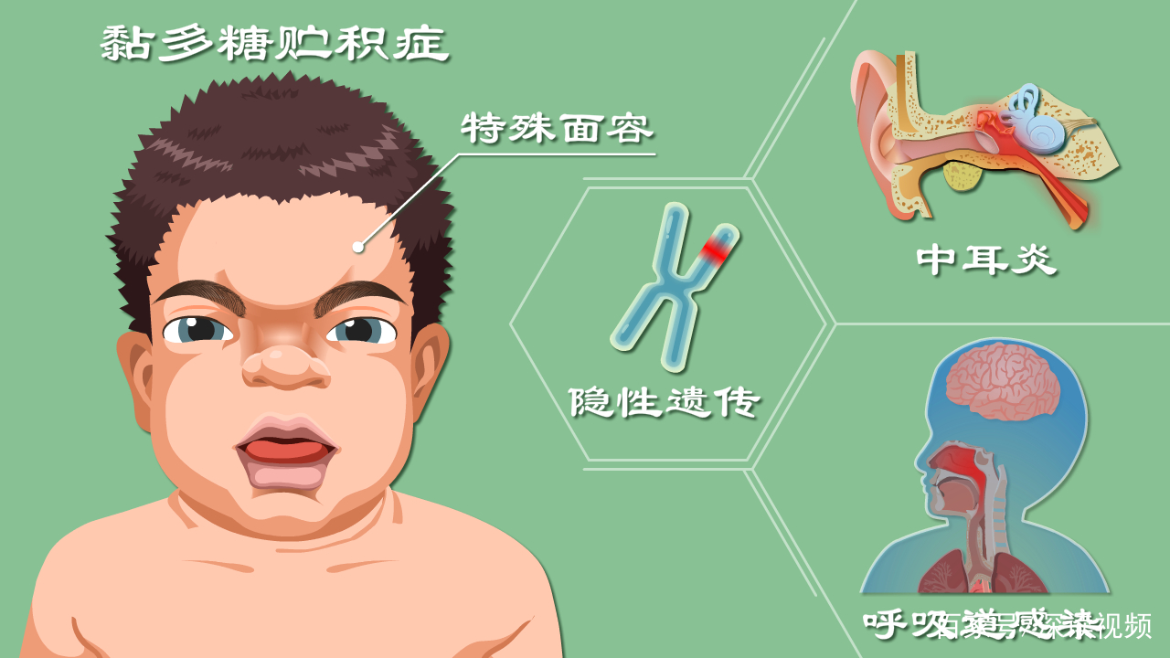 黏多糖贮积症