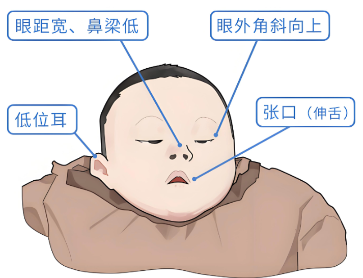 唐氏综合征表现