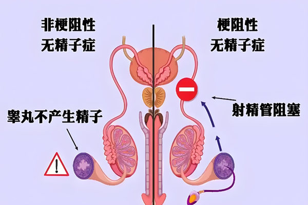 梗阻性无精症.png