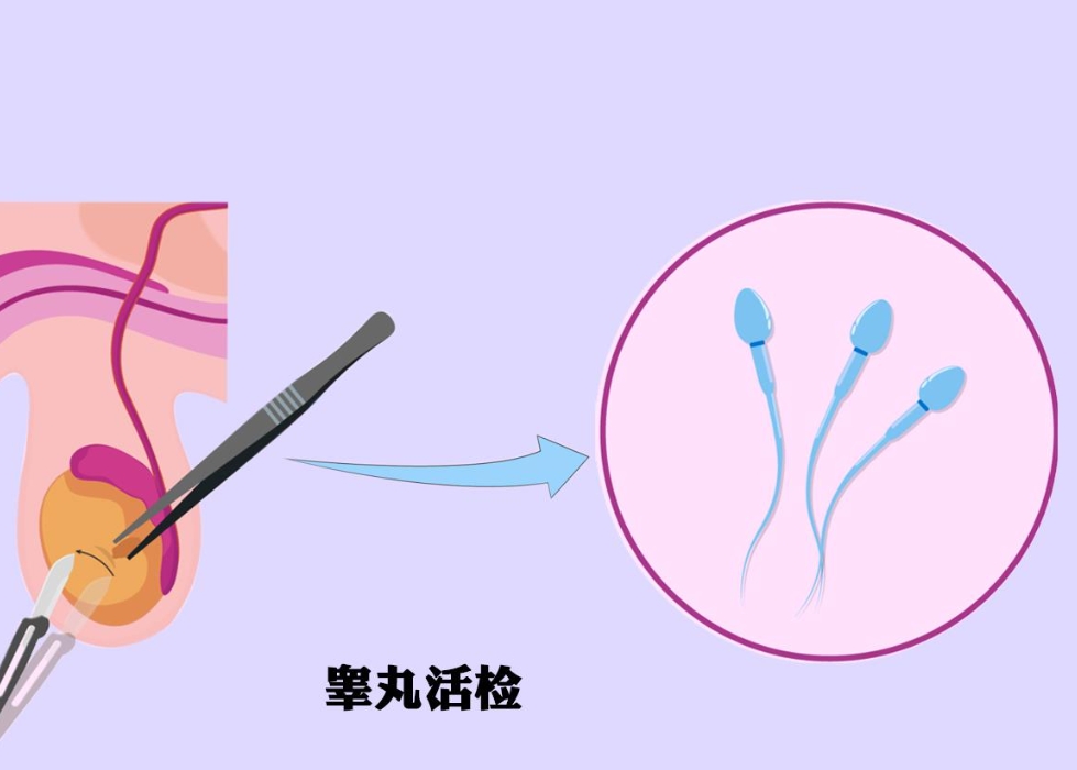 睾丸活检.png