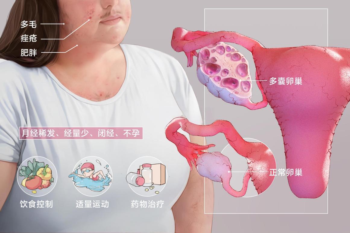 多囊卵巢综合征